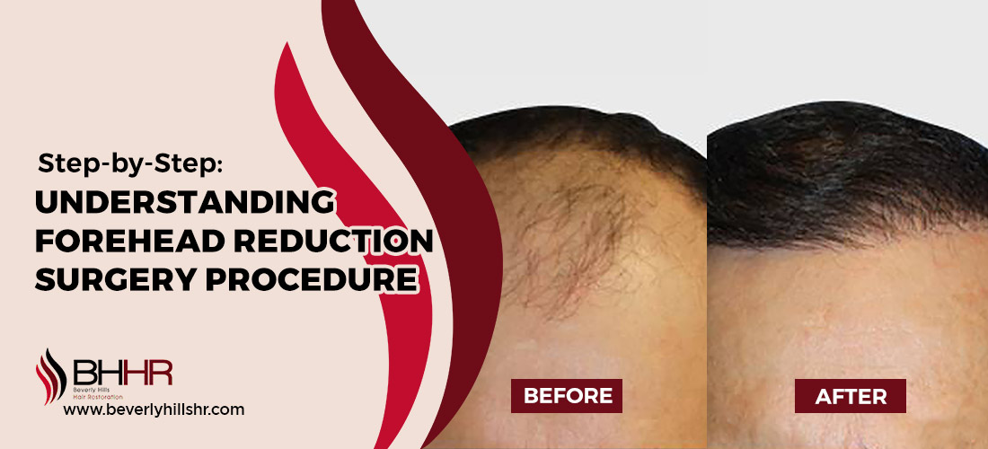 Forehead Reduction Surgery Procedure