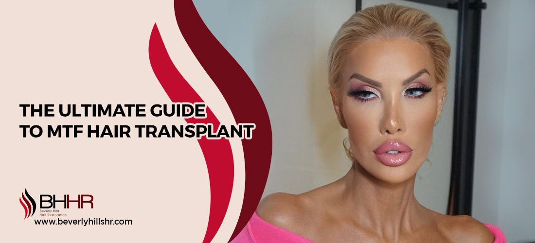 MTF hair transplant