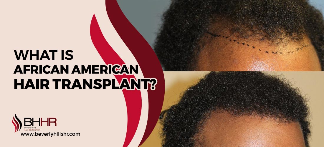 Hair Transplant African American 