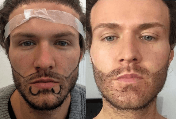 What is Beard Hair Transplant?