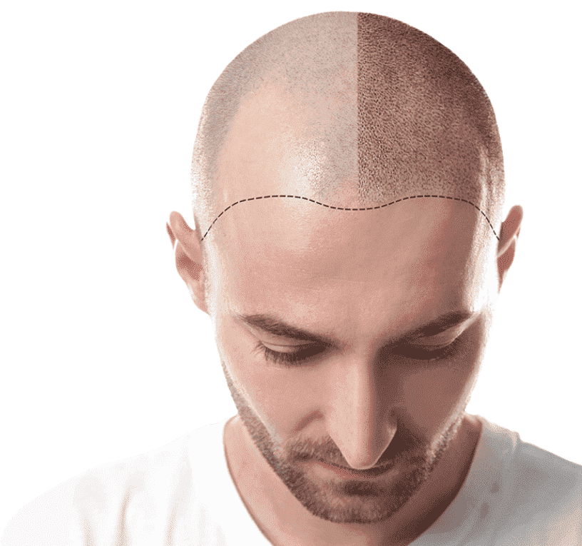 What is Scalp Micropigmentation?  